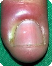 Profilaxia podal